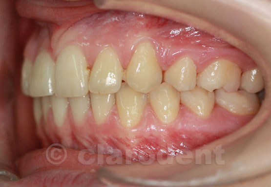 Ortodontie Caz 1