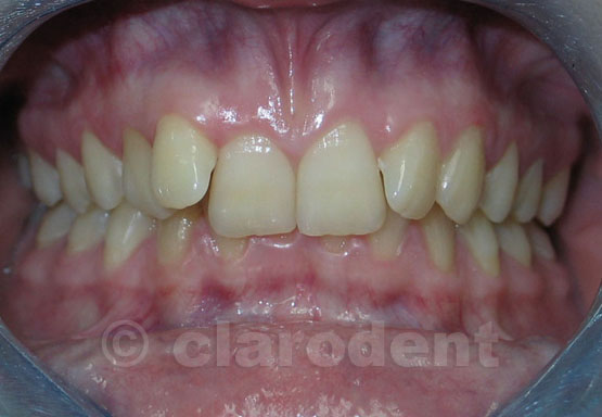 Ortodontie Caz 1
