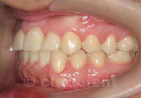 Ortodontie Caz 10