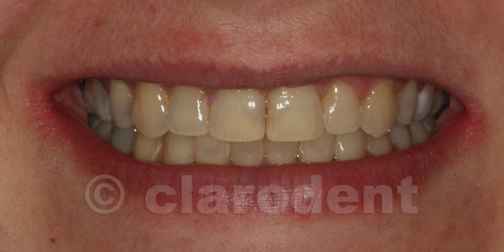 Ortodontie Caz 2