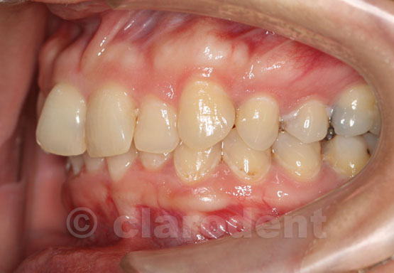 Ortodontie Caz 2