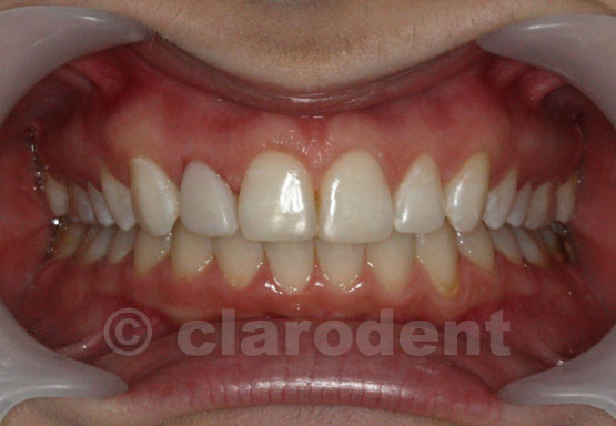 Ortodontie Caz 3