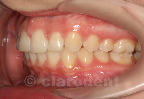 Ortodontie Caz 3