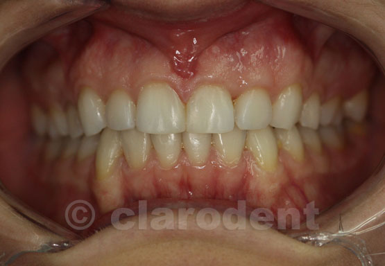 Ortodontie Caz 4