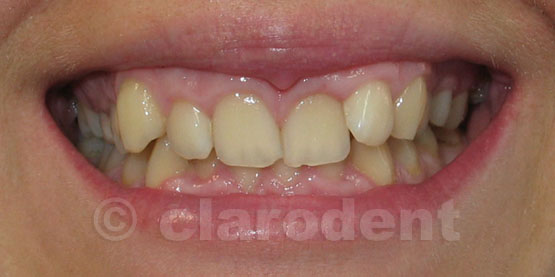 Ortodontie Caz 4
