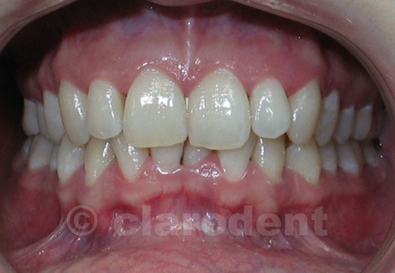 Ortodontie Caz 5