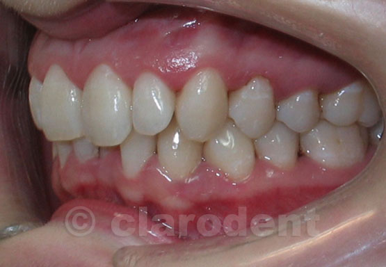 Ortodontie Caz 5