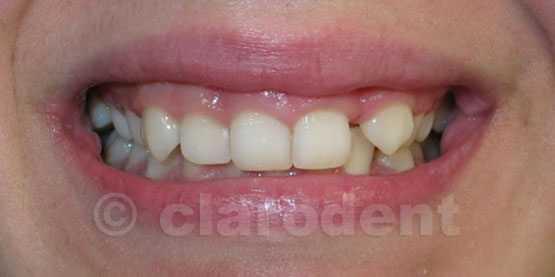 Ortodontie Caz 6