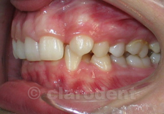 Ortodontie Caz 6