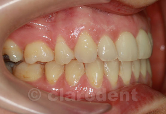 Ortodontie Caz 8