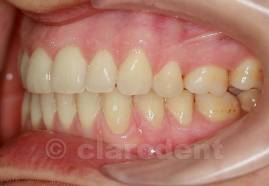 Ortodontie Caz 8